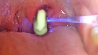 Worlds Greatest Tonsil Stone Removals 2 [upl. by Rozanna]