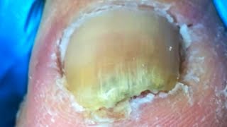 Complete dry toenail trimming process Remove dead skin [upl. by Hamid]