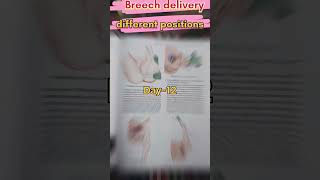 Beautiful Breech position delivery ♥️ c  section delivery ♥️ breech shorts viralvideo ✅🎯💯💯❓♥️ [upl. by Aeslek]