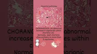 Placental pathology CHORANGIOSIS [upl. by Arikehs]