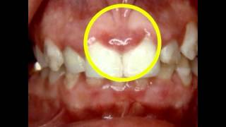 How Periodontal Disease Affects Pregnancy  Lake Merritt Dental Oakland CA [upl. by Rohn706]