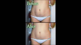 Whats the best stretch marks treatment [upl. by Mchale]