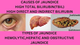 CAUSES OF JAUNDICECAUSES OF HIGH TOTAL BILIRUBINWHY IS MY DIRECT AND INDIRECT BILIRUBIN HIGH [upl. by Onifur]