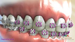 Orthodontic Braces  Different Parts 2 [upl. by Samtsirhc]