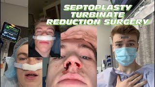 Septoplasty Turbinate Reduction Surgery Recovery vlog  tips ￼ [upl. by Denys842]