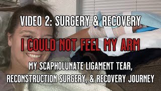 Scapholunate Ligament Tear and Reconstruction  Video 2 Surgery amp Recovery [upl. by Irfan795]