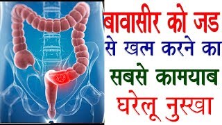 बवासीर को हमेशा हमेशा के लिए खत्म करने के सबसे असरदार घरेलु इलाज  Piles home remedies [upl. by Gyimah698]