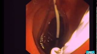 OvertheWire Stent Exchange Using a Simple Snare Technique in ERCP [upl. by Lacram753]