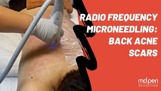 RF Microneedling Back Acne Scars Treatment [upl. by Lizned]