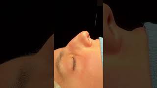 Male rhinoplasty in Houston [upl. by Aleyak]