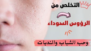 علاج حبوب الجبهة وحبوب تحت الجلد البارزة بسهولة  القضاء على تحبب الجلد وتنظيف مسام البشرة الدهنية [upl. by Hy756]