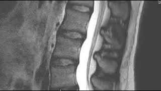 How to Read an MRI Scan of the Lumbar Spine  First Look MRI [upl. by Mimajneb]