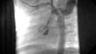 A Case of Coarctation in a Right Aortic Arch with an Aneurysmal Right Subclavian Artery and Aberran [upl. by Lindberg]