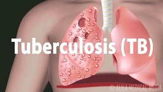 Tuberculosis TB Progression of the Disease Latent and Active Infections [upl. by Saenihp]