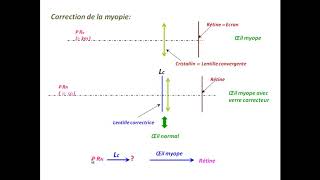 Comment corriger les défauts de l’œil  exercice corrigé en optique [upl. by Anoek]