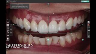 Dijital Gülüş Tasarımı Digital Smile Design [upl. by Woodruff]