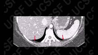 CT of Pleura  Anatomy amp Effusion  HD Basic Radiology [upl. by Macdermot]