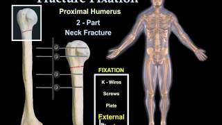 Fracture Fixation Animation  Everything You Need to Know  Dr Nabil Ebraheim [upl. by Notsa886]