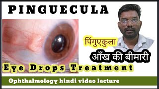 what is Pinguecula treatment  Pinguecula treatment Pinguecula treatment eye drops [upl. by Toddie]