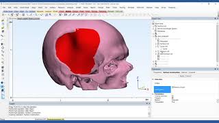 How to Design a PatientSpecific Cranial Plate  Mimics Innovation Suite  Materialise Medical [upl. by Arica]