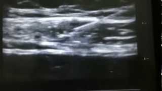 ultrasound guided subcostal tap block [upl. by Otrebmal]