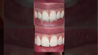 Crown lengthening for gum symmetry and new crown [upl. by Bracci]