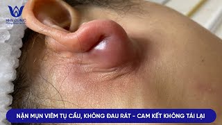 ĐIỀU TRỊ MỤN NHỌT  VIÊM TỤ CẦU  VÙNG VÀNH TAI  CAM KẾT KHÔNG TÁI LẠI KHÔNG ĐỂ LẠI SẸO [upl. by Audris]