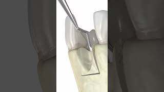 Dental bone graft 3d animation medicalanimation dentalprocedure [upl. by Annayar204]