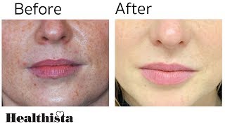 Rejuvenate Lips with Belotero Fillers Treatment [upl. by Nyrahtak]