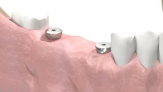 SIC invent Dental Implant  Prosthetic Animation BridgeWork Open Tray Technique [upl. by Ferris371]