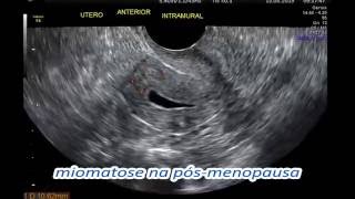 MIOMA UTERINO MIOMATOSE UTERINA DIAGNÓSTICO ULTRASSONOGRÁFICO  ECOGRÁFICO  CLÍNICA SARRAFF [upl. by Alesig]