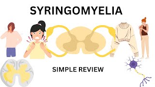 syringomyelia  featurescauses and treatment [upl. by Nerraf]