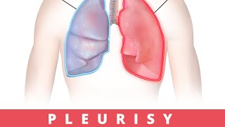 Pleurisy Causes Symptoms and Treatment [upl. by Yenitirb650]