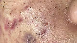 Blackheads Extraction Whiteheads Removal Pimple Popping 2 [upl. by Ojytteb]