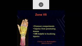 MRI of the Wrist Part 8  Wrist Tendons [upl. by Forland117]