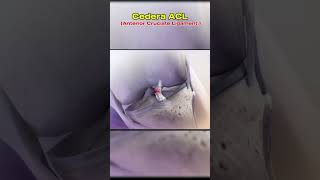 Cedera ACL  Anterior Cruciate Ligament [upl. by Sadnalor]