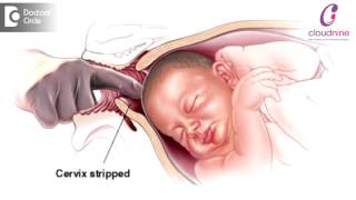 Methods of Labour Induction  Dr Padmini Isaac  Cloudnine Hospitals [upl. by Tatiana860]