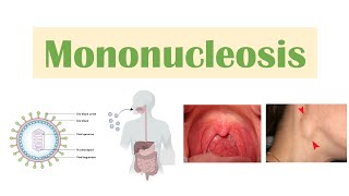 Infectious Mononucleosis Mono  EpsteinBarr Virus Transmission Symptoms Diagnosis Treatment [upl. by Syst]