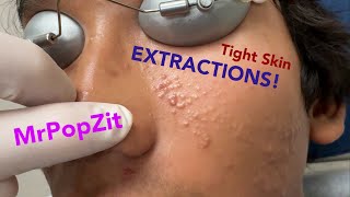 Tight skin acne extractions Comedonal acne with some inflammatory nodules Great session must see [upl. by Kcirdlek824]