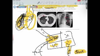 PNEUMOTHORAX FROM FIRST AID USMLE STEP 1 URDUHINDI [upl. by Ivatts]