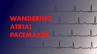 Wandering Atrial Pacemaker  EKG ECG Interpretation [upl. by Cykana]