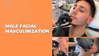 MALE FACIAL MASCULINIZATION WITH DERMAL FILLERS  Dr Jason Emer [upl. by Francene]