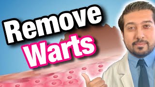 Wart Removal 101  How to Get Rid of Warts [upl. by Asare]