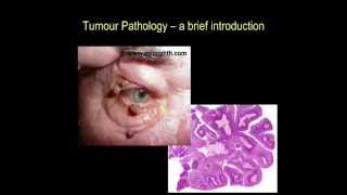 Tumour pathology  a brief introduction part II [upl. by Xed935]