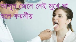 মুখে ঘা মারাত্মক কোনো রোগ নয় দেখুনMukhe Gha Hole Koronioমুখে ঘা হলে কি করবেন [upl. by Alisun]