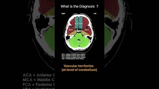 Vascular territories  at level of cerebellum CT Brain Anatomy Quiz 34 radiologychannel007 [upl. by Nylarahs]