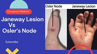 Janeway Lesions Vs Oslers Nodes Simplified Approach [upl. by Chere]