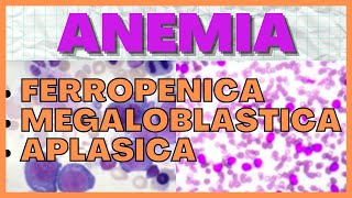 Anemia Ferropenica Megaloblastica y Aplasica FISIOPATOLOGIA [upl. by Nakashima477]