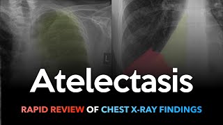 Atelectasis Rapid Review of Chest Xrays [upl. by Kristos]