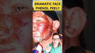 Dangerous CHEMICAL PEEL Results  Phenol Peel Before and After  shorts [upl. by Lleruj]